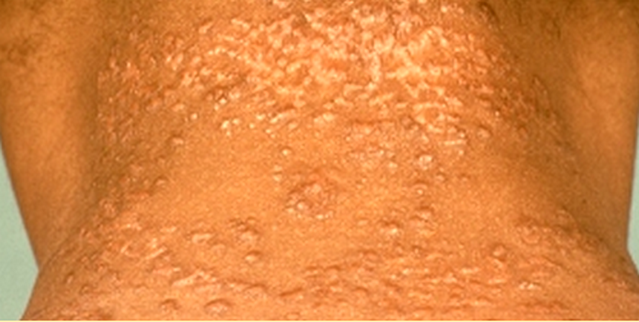 Dark Skin Patches or Acanthosis Nigricans and PCOS