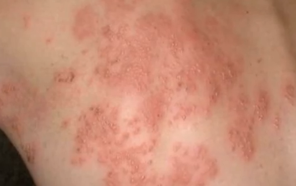 Itchy Back Rash Pictures, Skin Problems and Other Causes ...