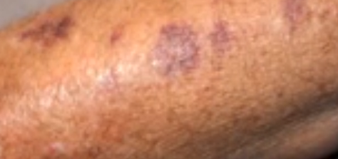 purple spot on skin