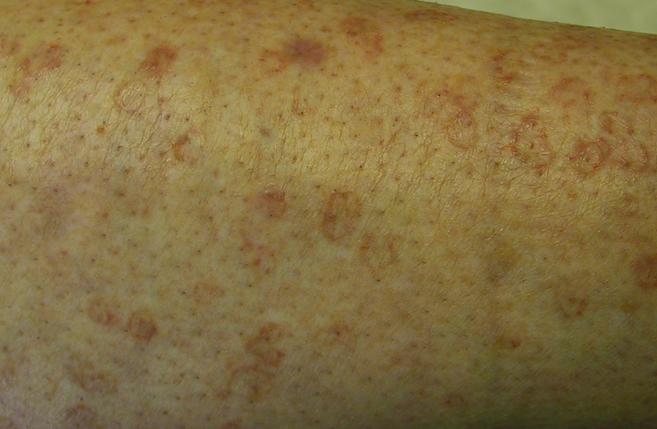 Red Spots On Arms