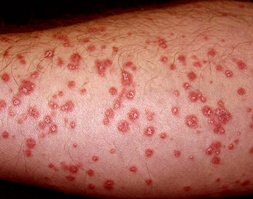 red patches on arm