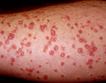 Spots on Skin: Pictures, Causes and Treatment