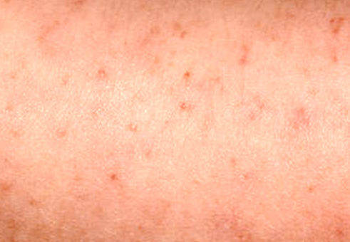 viral skin rash #10