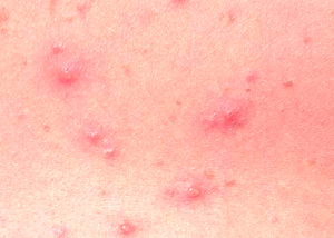 Different Types of Rashes - Parents