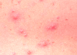 Kids Health Info : Rashes caused by viruses