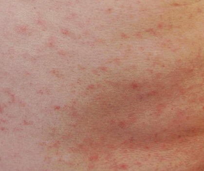 Rash bumps anus hiv