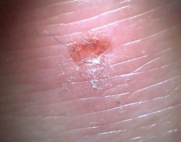 Morgellons Disease: What Is It? - WebMD