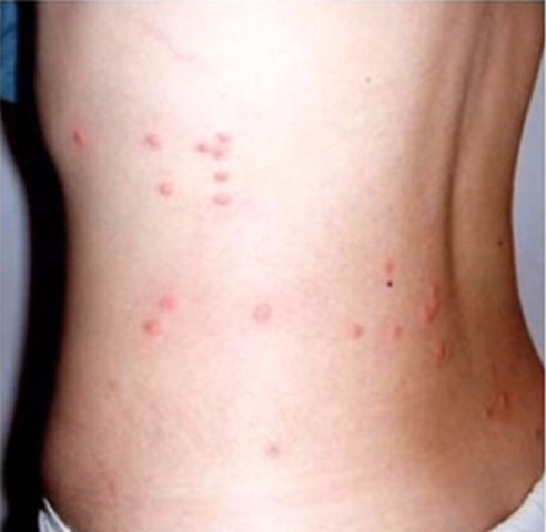 Flea Allergy Dermatitis In Humans - HealthTap