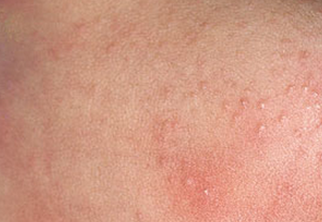 What is a menopause rash?