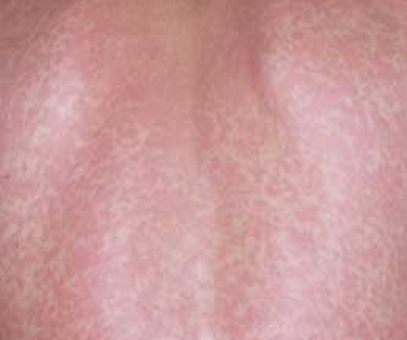 What To Do About Anxiety Rash? - Calm Clinic