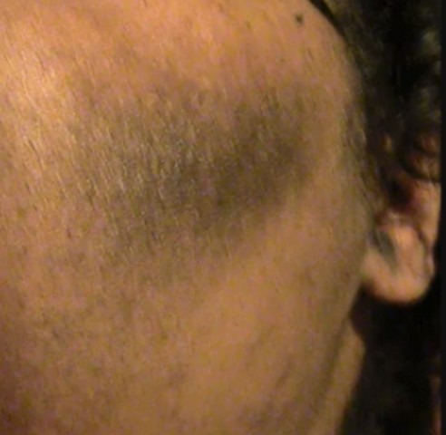 acanthosis nigrican treatment #11