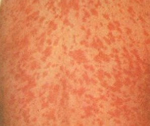 Red Dots on Skin, Little, Small ... - lightskincure