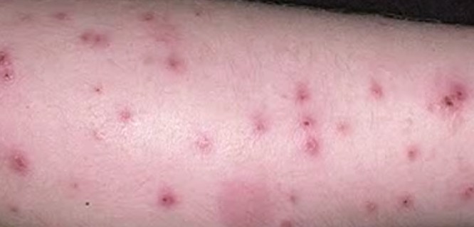 Bed Bug Rash Treatment Pictures to pin on Pinterest