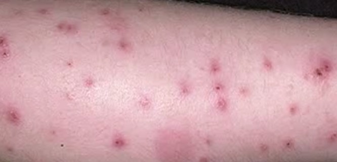 Bed Bug Bite Pictures, Marks, Symptoms, Causes, Treatment