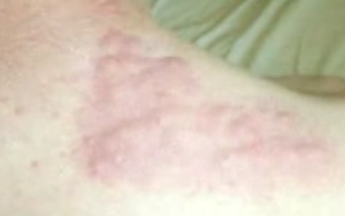Bed Bug Bite â€“ Pictures, Symptoms, Treatment