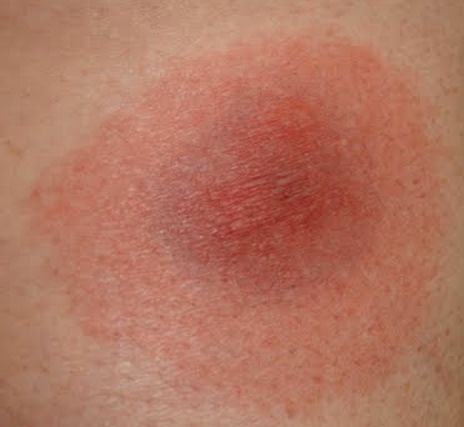 Lyme Disease Pictures: Causes, Tests, Prevention, & More