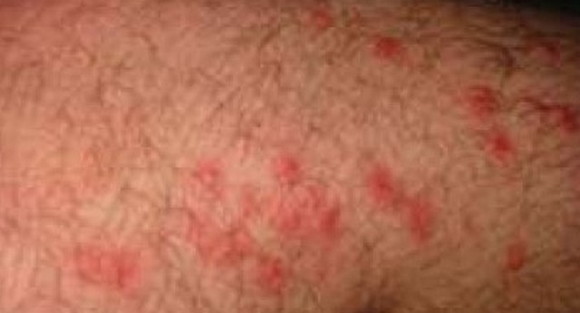 Poison Ivy Rash – Pictures, Symptoms, Causes, Treatment : Medical Treasure