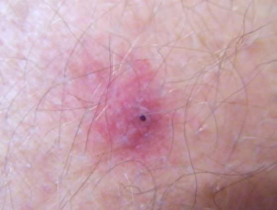 Pictures of Tick Bites, Symptoms, Causes, Treatment