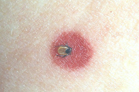 Where can you find photos of tick bites?