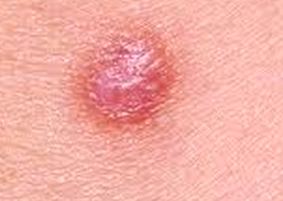 Picture of Dermatofibroma - WebMD