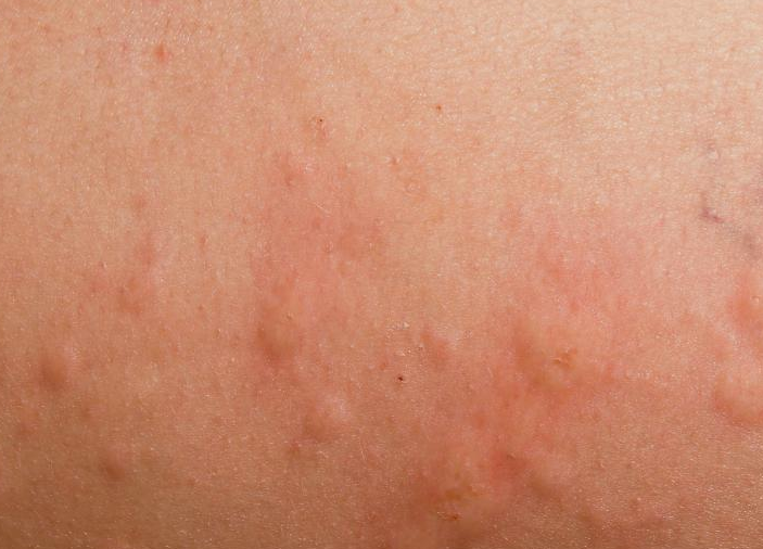 hot tub rash treatment pictures, photos