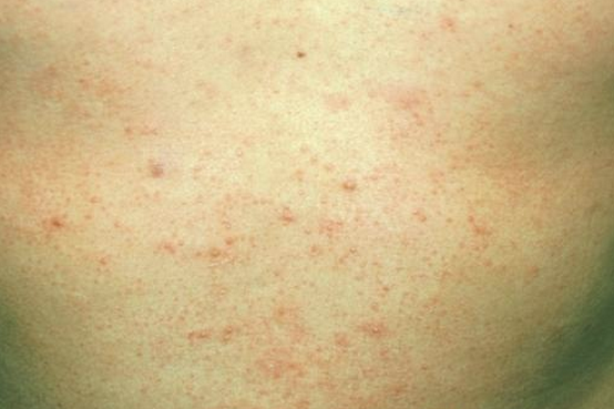 Folliculitis - Pictures, Symptoms, Causes, Types, Treatment