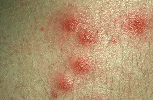 Folliculitis: Background, Pathophysiology, Epidemiology