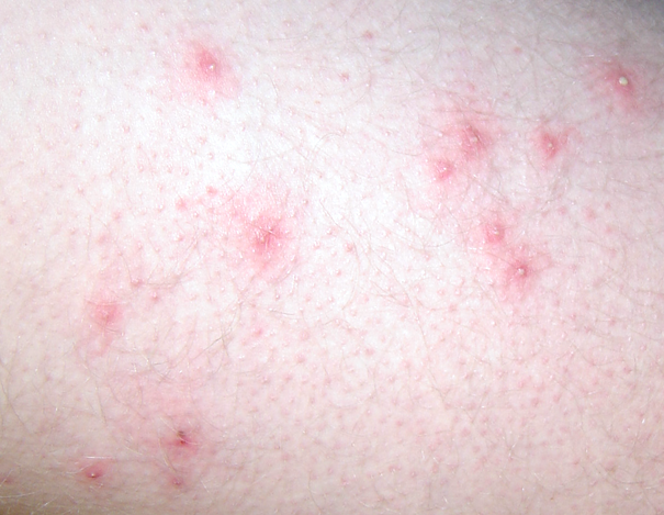 mild folliculitis