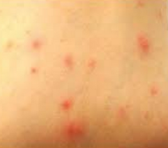 Hot Tub Rash - Pictures, Treatment, Symptoms, Causes