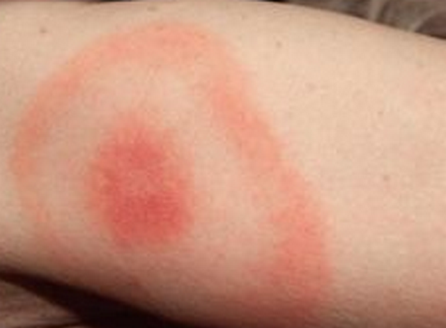 Tick Pictures and Treatment and Symptoms of Tick Bites