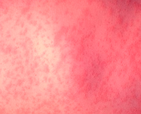 Kids Health Info : Rashes caused by viruses