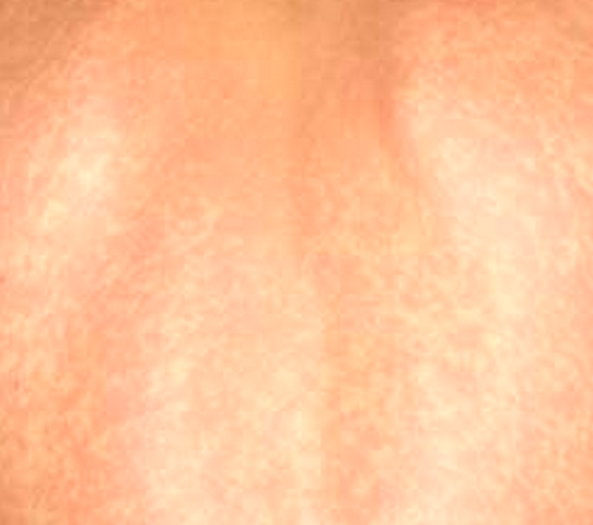 Shingles Rash Pictures, Symptoms, Vaccine Facts