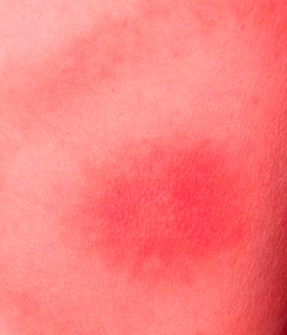 What are the signs of West Nile virus?