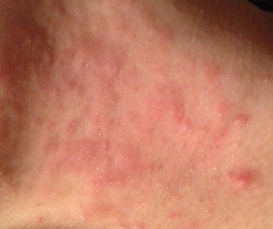 Can Dh Be Mild? - Dermatitis Herpetiformis - Celiac.com ...
