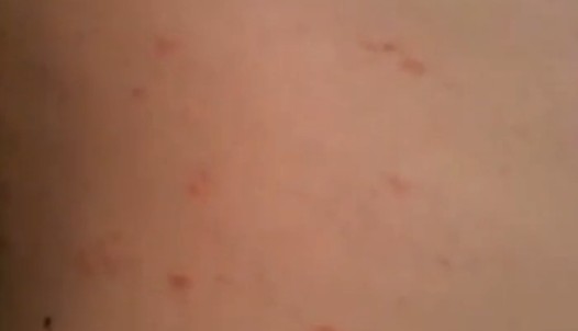 Dermatitis herpetiformis - Wikipedia