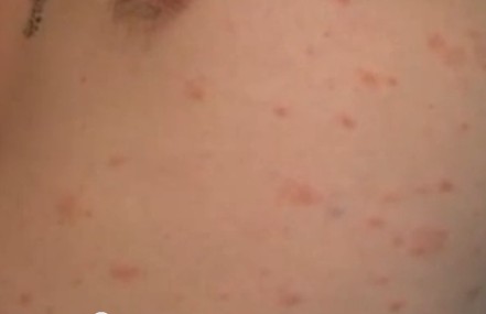 Dermatitis Herpetiformis