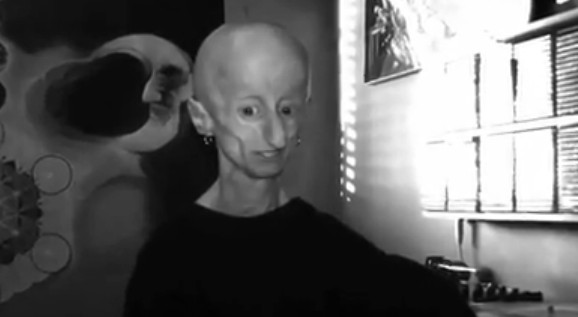 Progeria - Facts, Pictures, Symptoms, Causes, Treatment ...