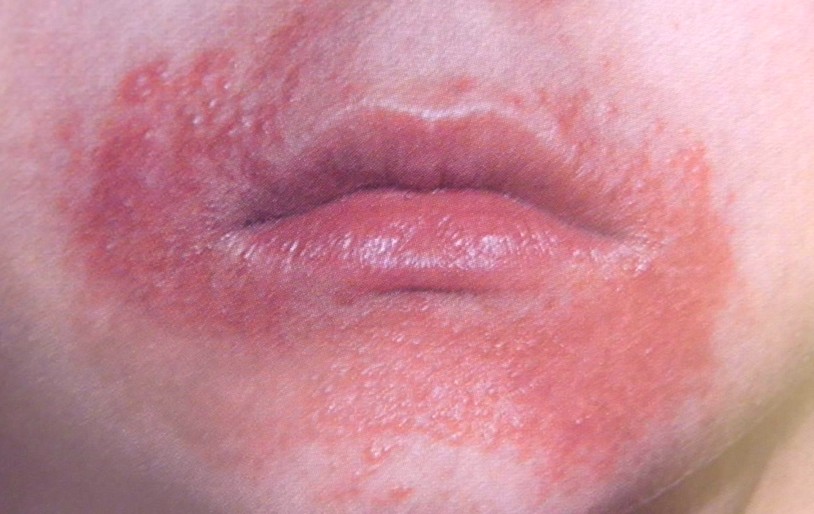Seborrheic Dermatitis on Face Treatment, Symptoms and