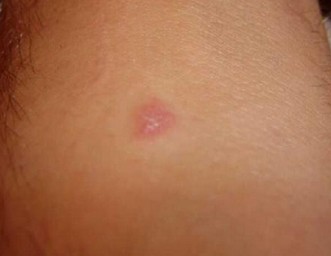 gnat bites pictures