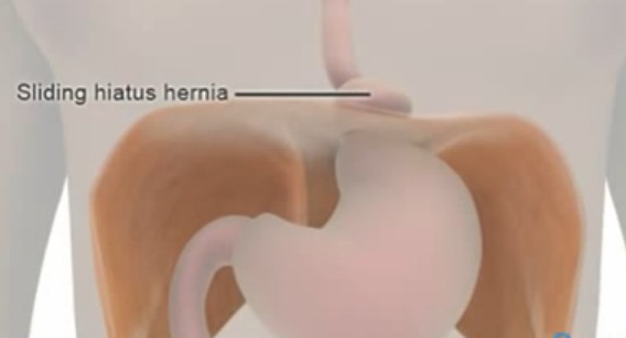 Hiatal hernia definition wikipedia