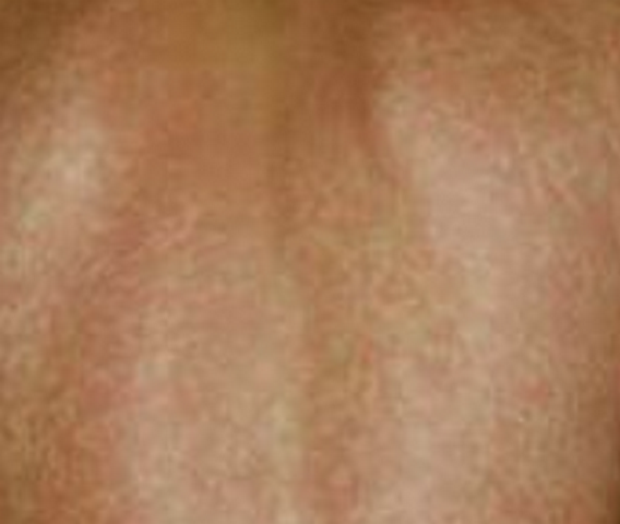 Lamictal rash picture a comprehensive view