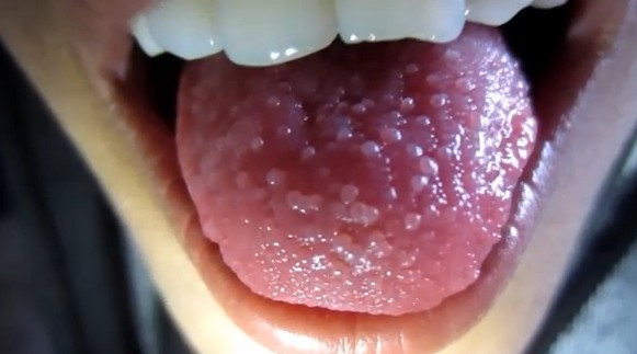 white-bumps-on-tongue-causes-and-treatment