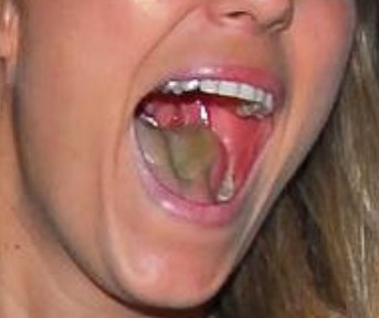 What causes a brown tongue?