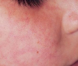 Slide show: Common skin rashes - Mayo Clinic