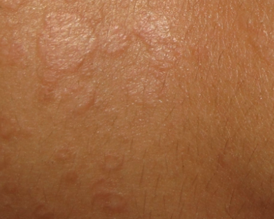 Tinea versicolor | American Academy of Dermatology