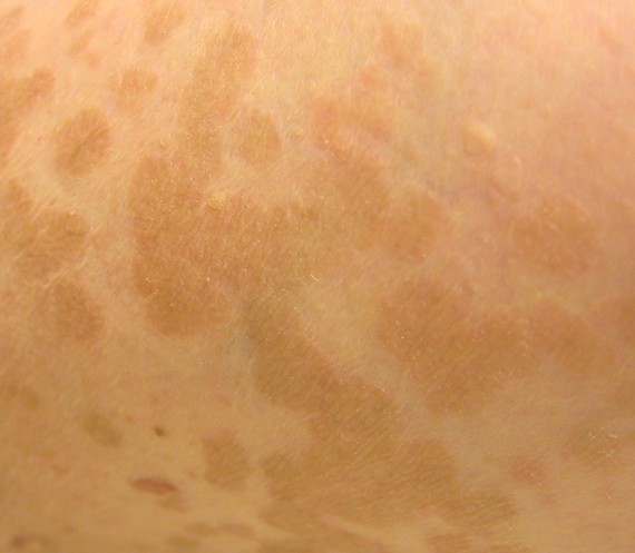 Tinea versicolor: MedlinePlus Medical Encyclopedia