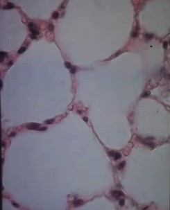 Squamous Epithelial Cells in Urine: Causes, Test, Results