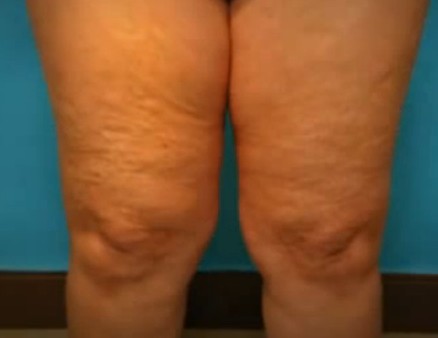 How to get rid of Cellulite on Thighs, Legs Naturally?