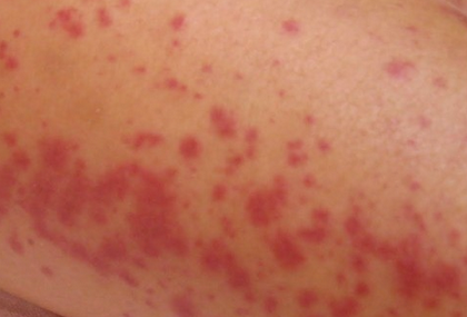 Hives (Urticaria) | Causes, Symptoms & Treatment | ACAAI ...