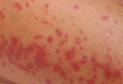 diabetes legs rash